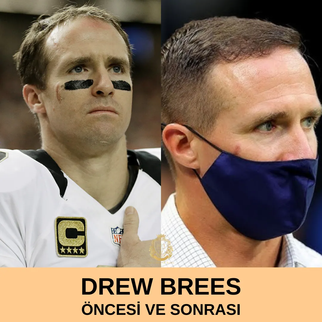 Trasplante de pelo de Drew Brees 1 Drew Brees Hair Transplant|Drew Brees Saç Ekimi