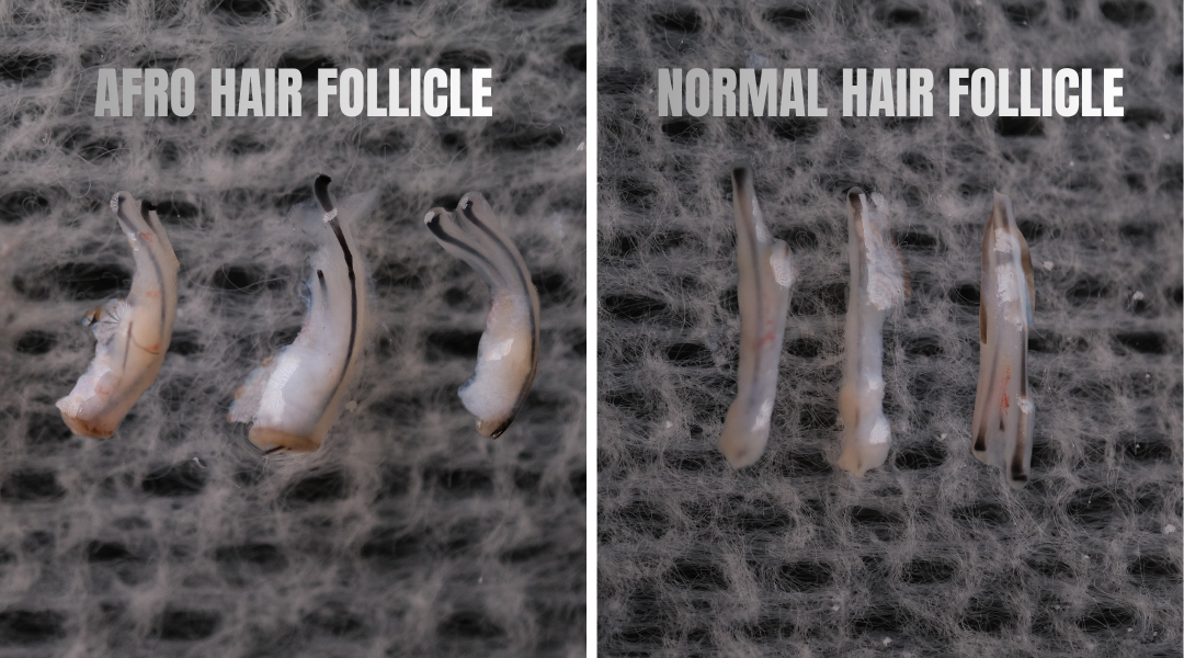 Afro Hair Transplant 4 Afro Hair Transplant