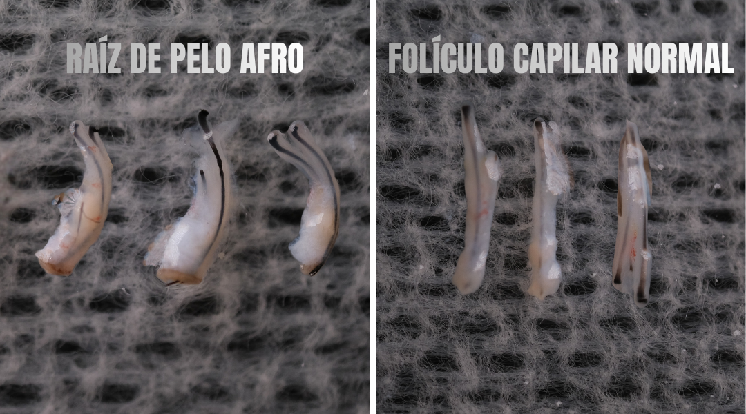 Trasplante Capilar Afro en Turquía 4 Trasplante Capilar Afro en Turquía