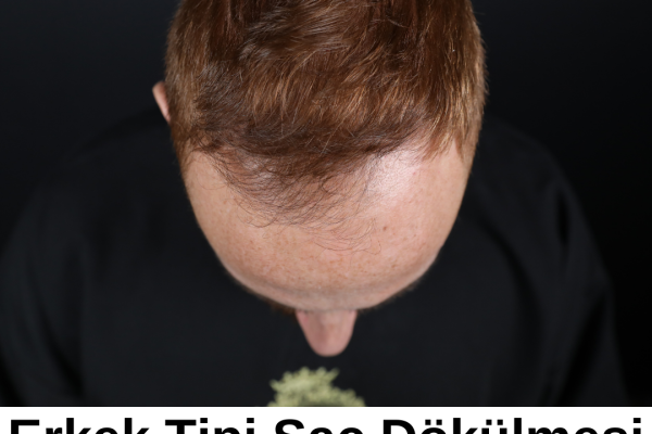 Qual a idade em que começa a calvície masculina?