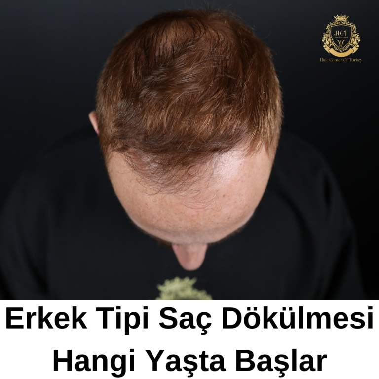 What Age Does Male Pattern Baldness|Erkek Tipi Saç Dökülmesi Hangi Yaşta Başlar