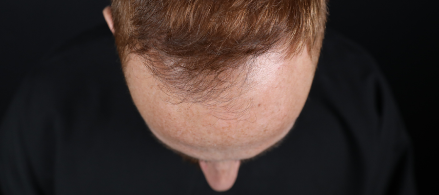 What Age Does Male Pattern Baldness|Erkek Tipi Saç Dökülmesi Hangi Yaşta Başlar