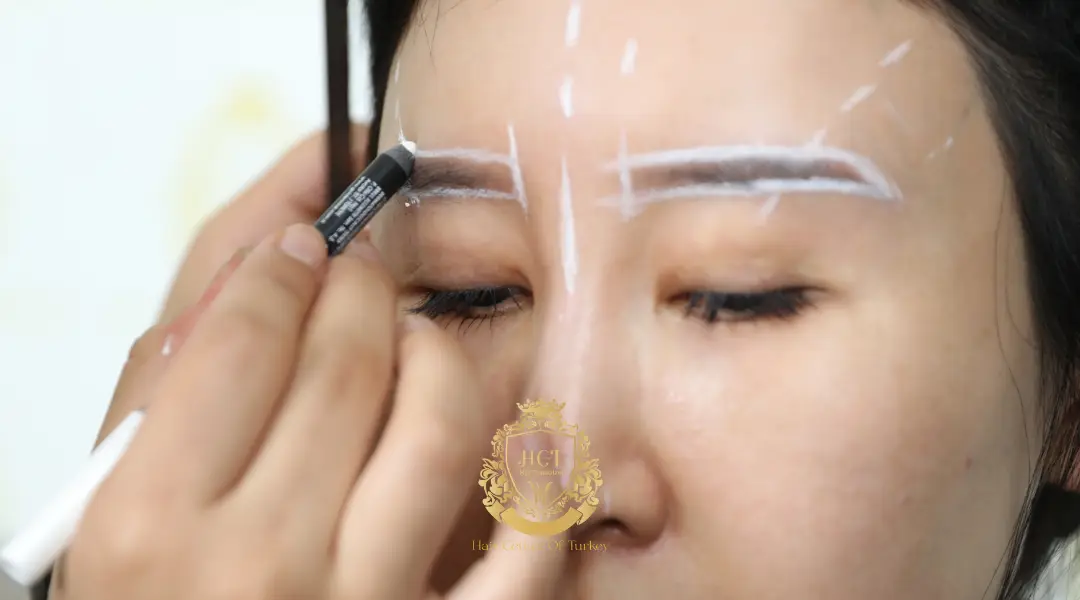 Eyebrow Transplant in Women