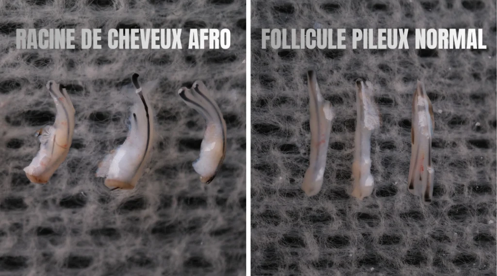 Greffe de Cheveux Afro en Turquie 4 Greffe de Cheveux Afro en Turquie