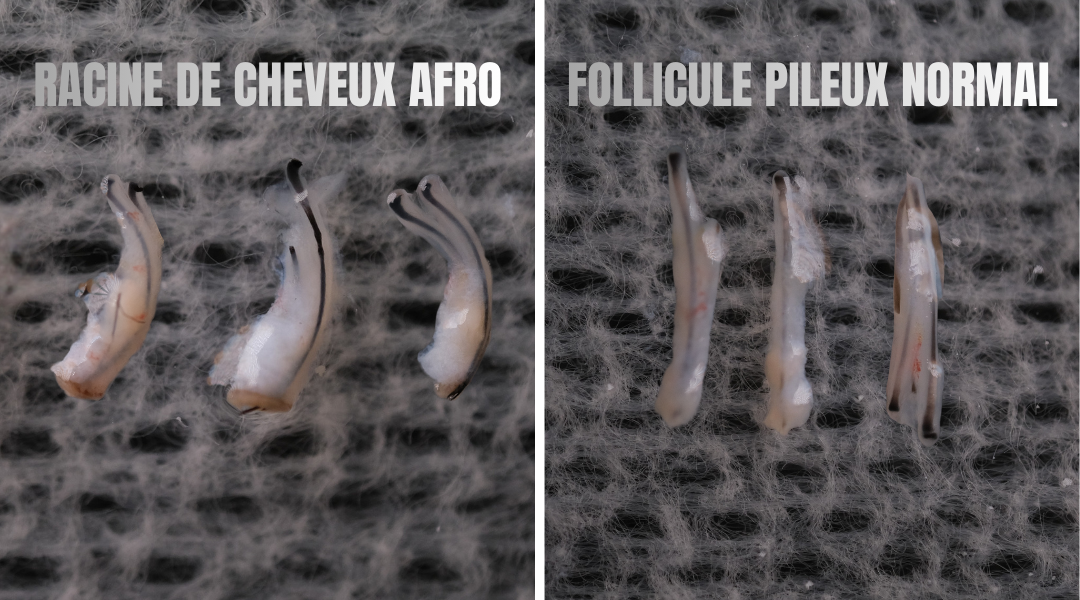 Greffe de Cheveux Afro en Turquie