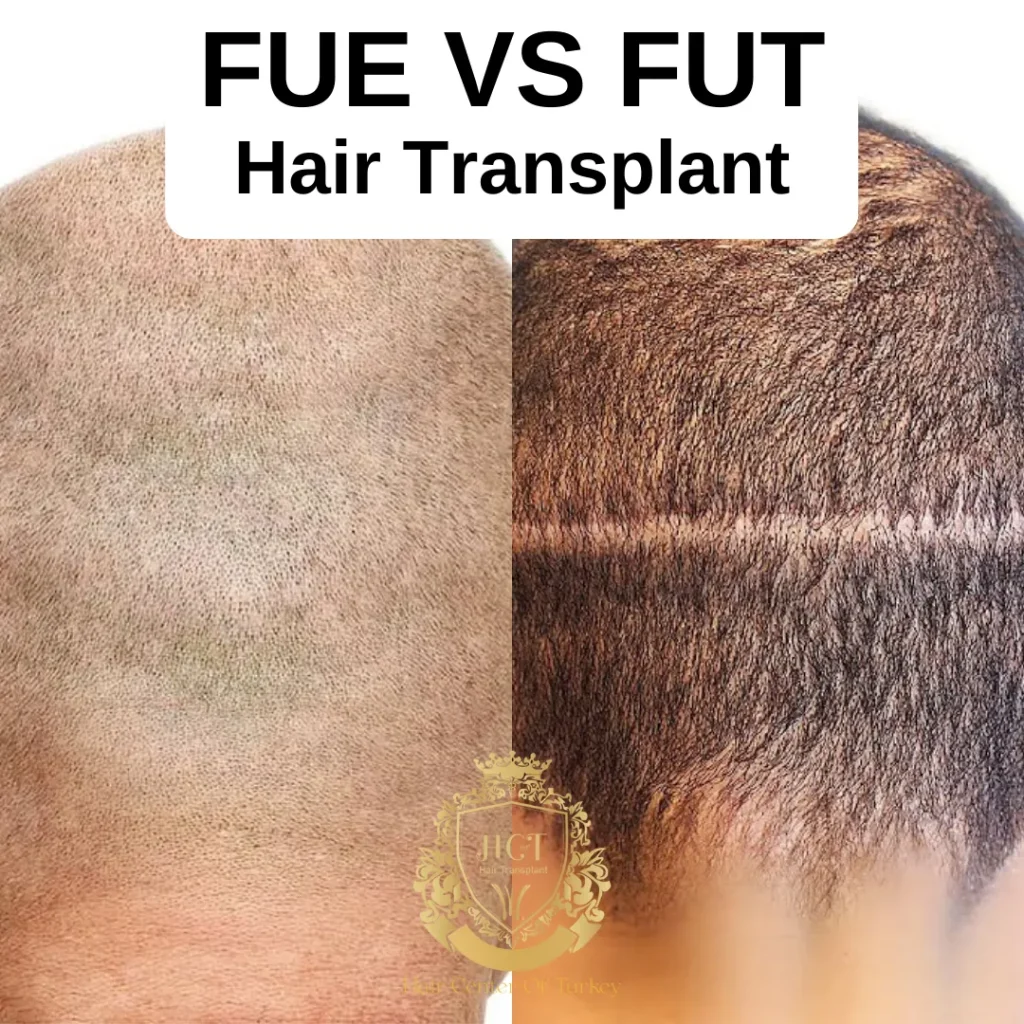 FUE vs. FUT: Vilken hårtransplantationsteknik är bättre?