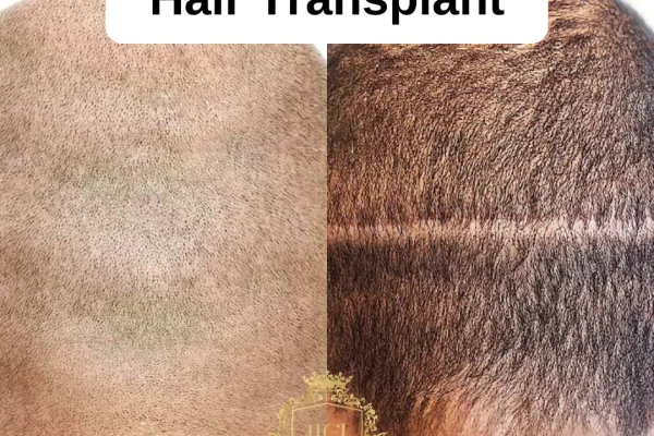 FUE vs. FUT: Which Hair Transplant Technique is Better?