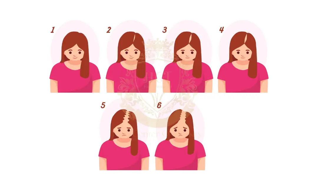 Female Hair Loss Type women hair transplant