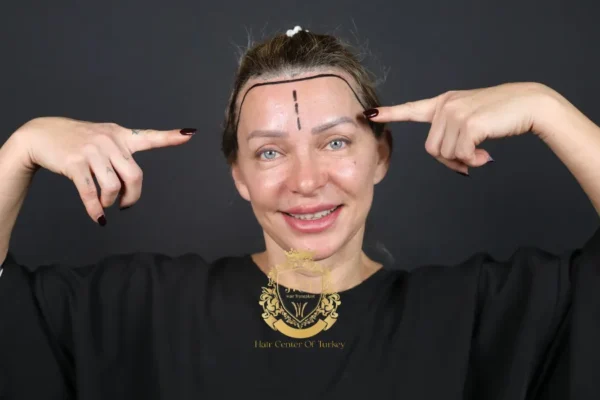 Haartransplantatie bij Vrouwen