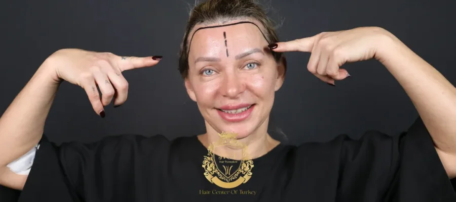 Female Hair Transplant