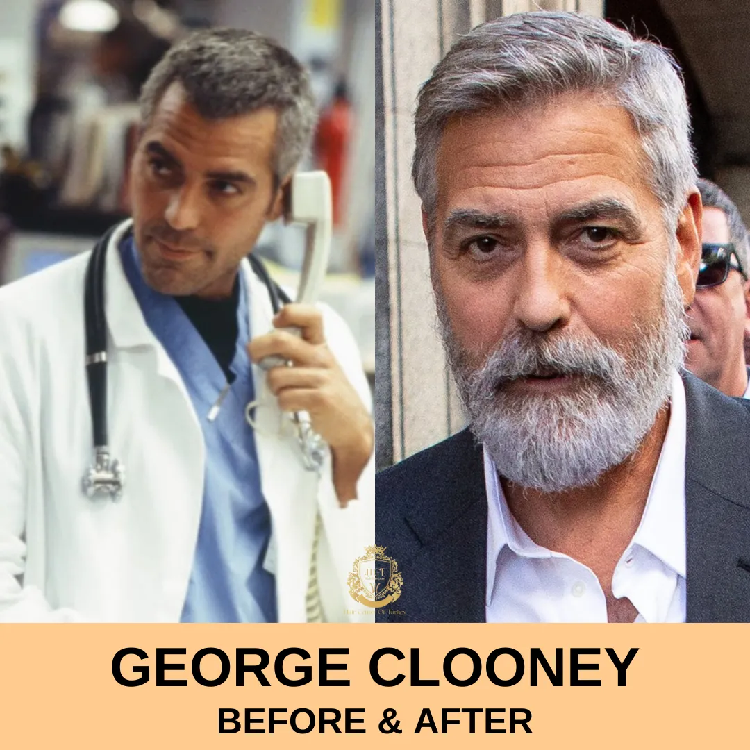George Clooney Hair Transplant 1 George Clooney Hair Transplant
