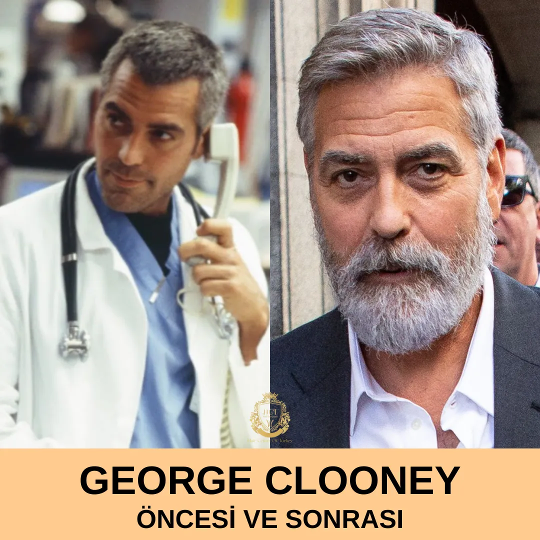 George Clooney Hair Transplant|George Clooney Saç Ekimi