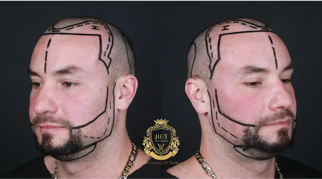 Trasplante de Barba 4 Hair and Beard Transplant