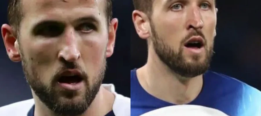 Harry Kane Hair Transplant