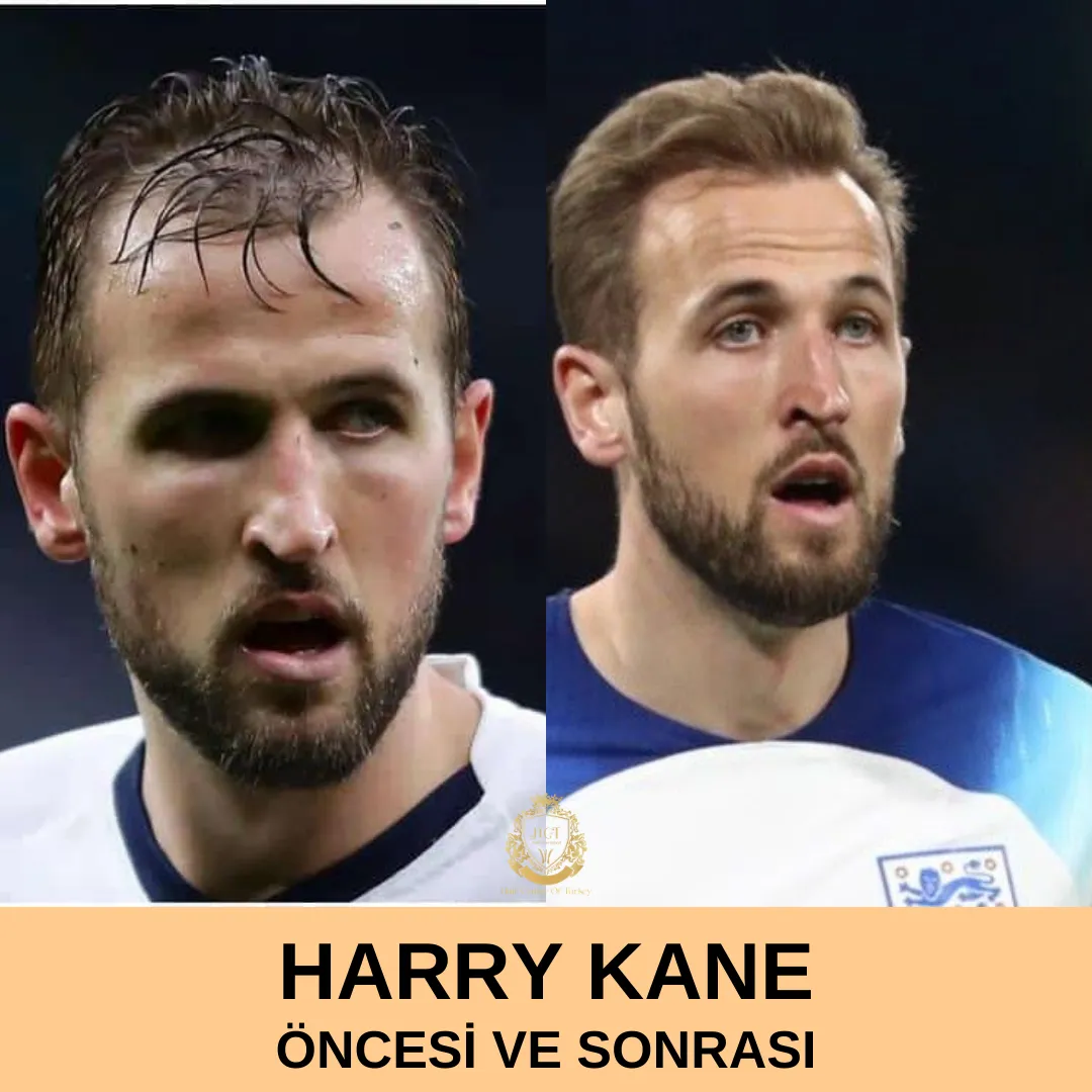 Harry Kane Saç Ekimi 1 Harry Kane Hair Transplant