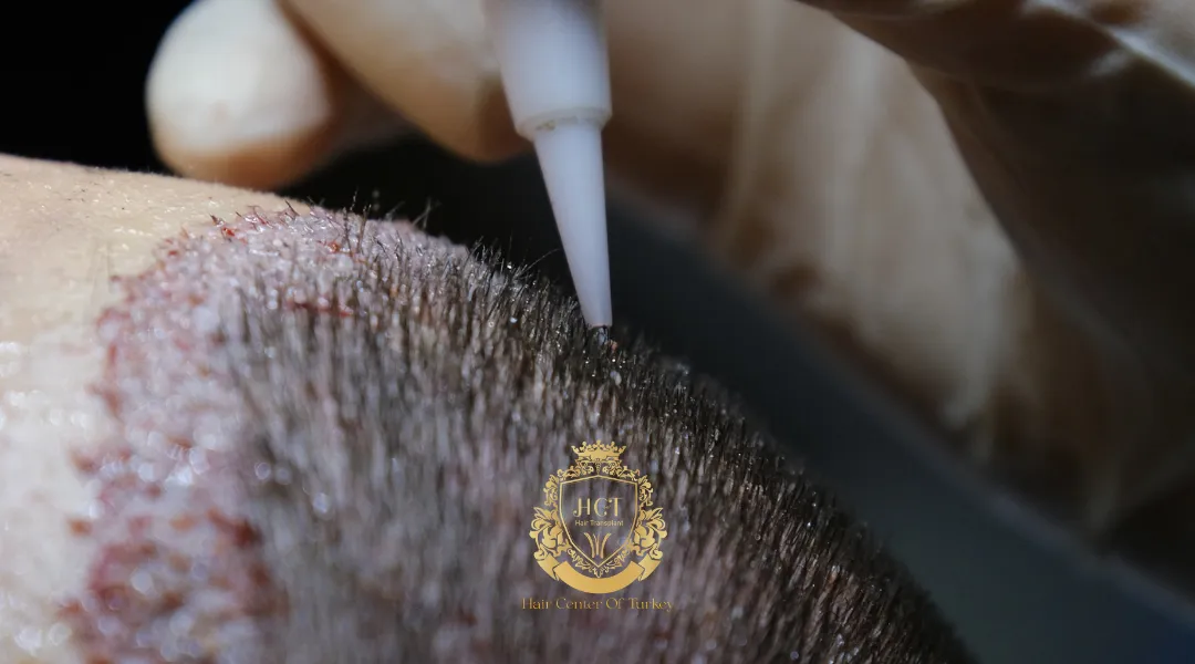 How A Hybrid Hair Transplant Works