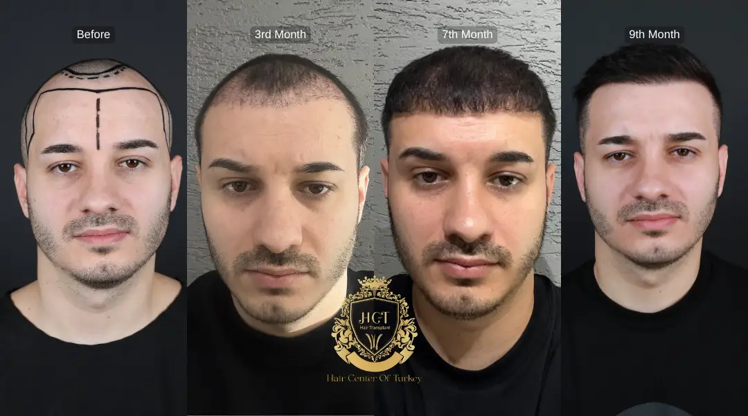 How DHI Hair Transplant Works Step By Step