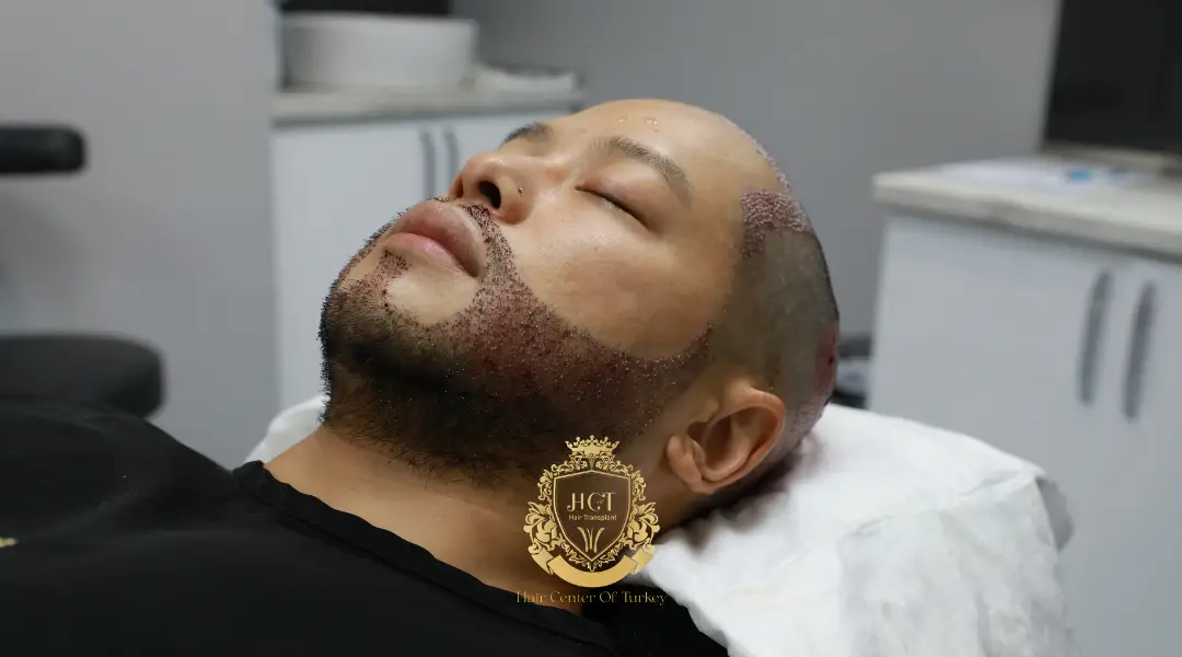 Trasplante de Barba 3 How Long Does a Beard Transplant Take