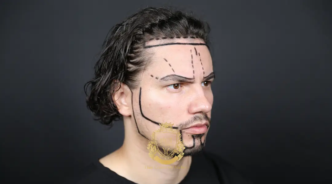 How to Transplant Eyebrow