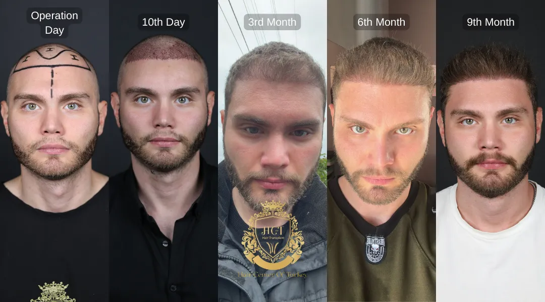 Hybrid Hair Transplant recovery process