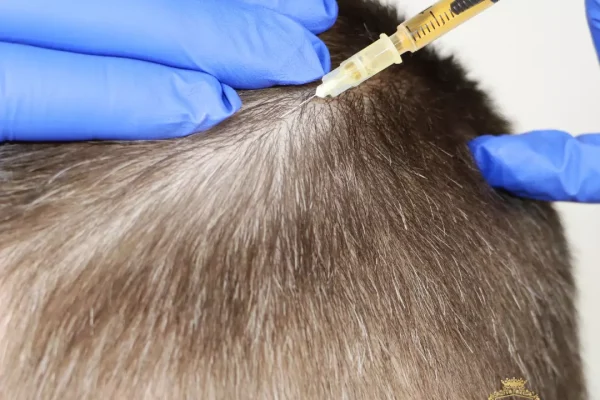 IGF Hair Treatment: What It Is, How It Works, And Who It’s For