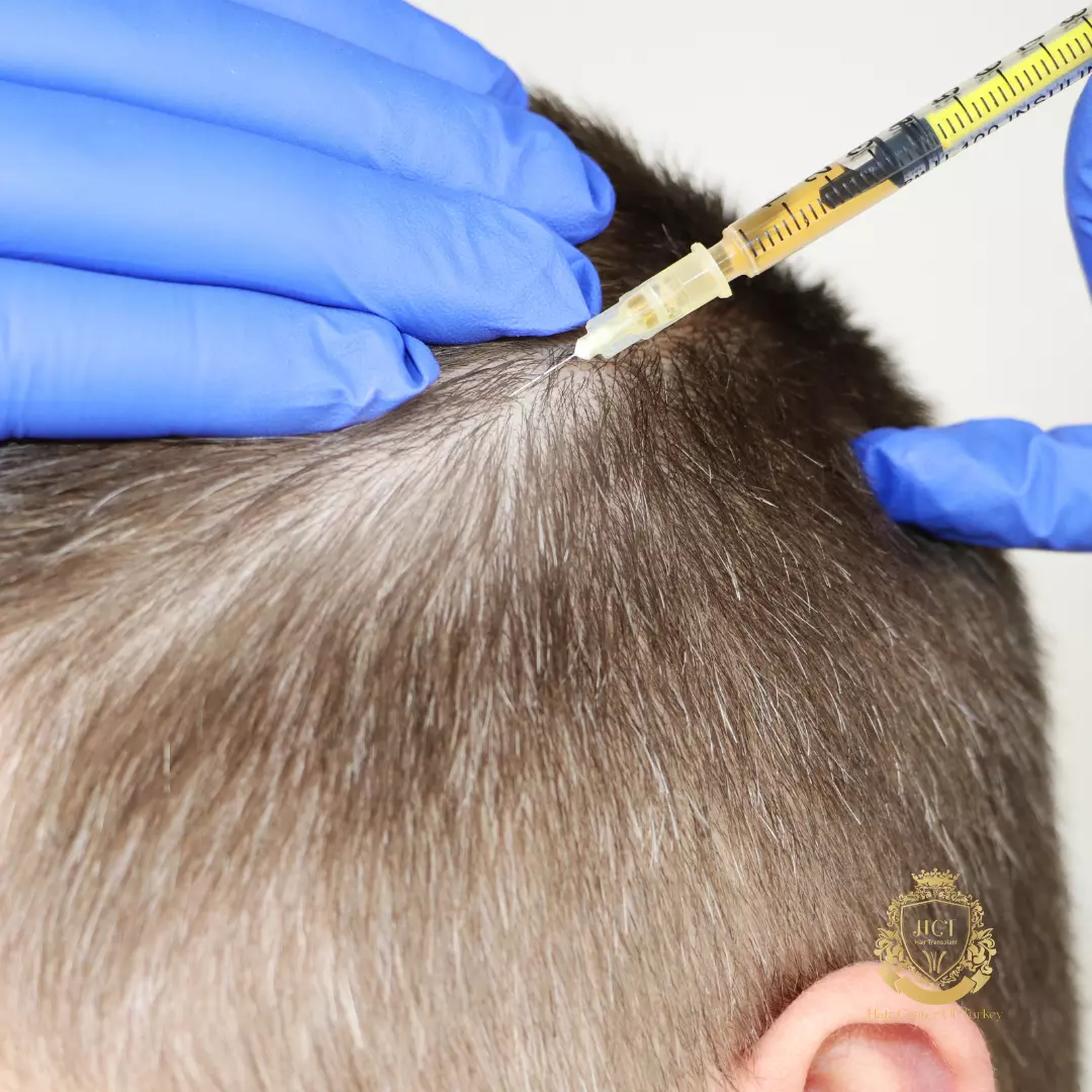 ¿Que Es El Transplante De Cabello Con AGF-39? 1 ¿Que Es El Transplante De Cabello Con AGF-39?