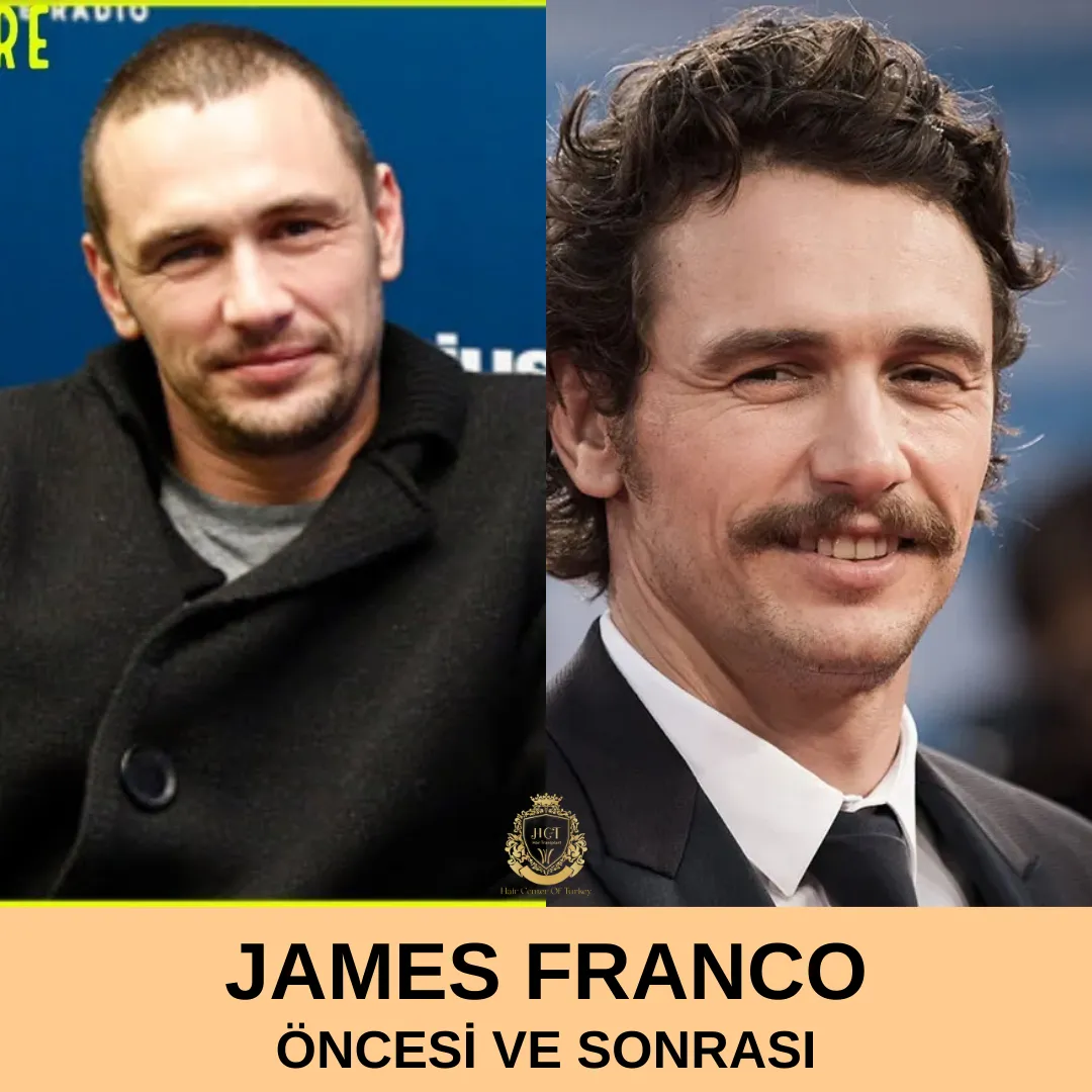 James Franco Hair Transplant|James Franco Saç Ekimi