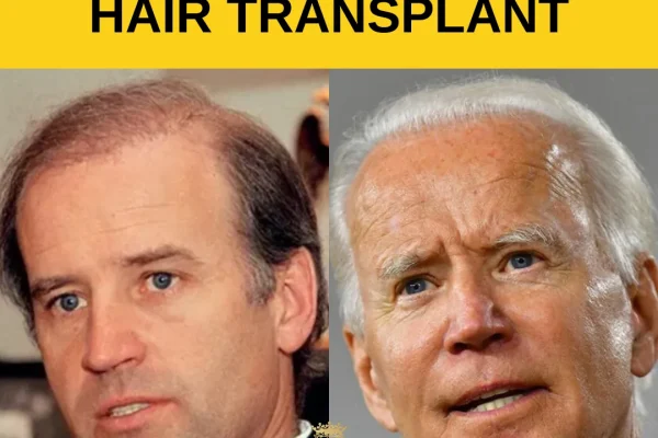 Joe Bidens Haartransplantation: Was Bekannt Ist, Was Spekuliert Wird Und Grundlagen Der Haarwiederherstellung (2026)