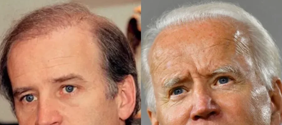 Joe Bidens Haartransplantation: Was Bekannt Ist, Was Spekuliert Wird Und Grundlagen Der Haarwiederherstellung (2026)