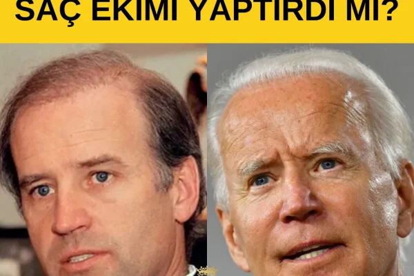 Greffe De Cheveux De Joe Biden : Ce Que L&rsquo;on Sait, Ce Que L&rsquo;on Suppose Et Les Bases De La Restauration Capillaire (2026)