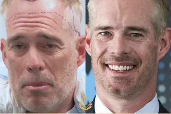 Joe Buck Haartransplantation