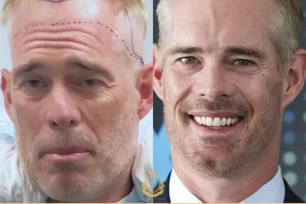 Joe Buck Haartransplantatie