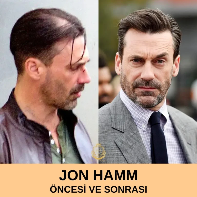 Jon Hamm Hair Transplant|Jon Hamm Hair Transplant TR befaf