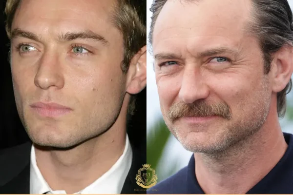 Jude Law Haartransplantation