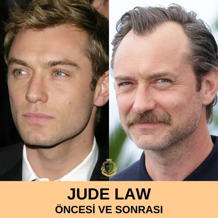 Jude Law Hair Transplant|Jude Law Saç Ekimi Öncesi ve Sonrası