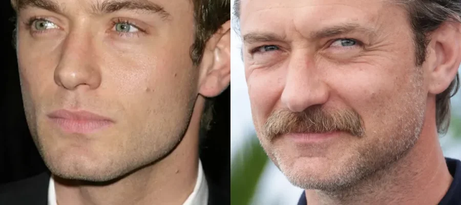 Jude Law Hair Transplant|Jude Law Saç Ekimi Öncesi ve Sonrası