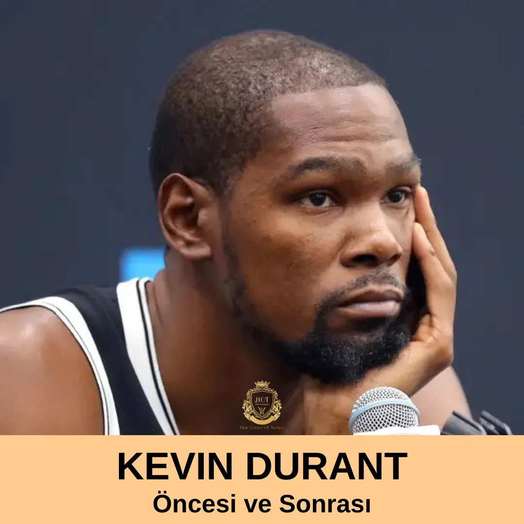 Kevin Durant'ın saç ekimi 1 Kevin Durant Hair Transplant|