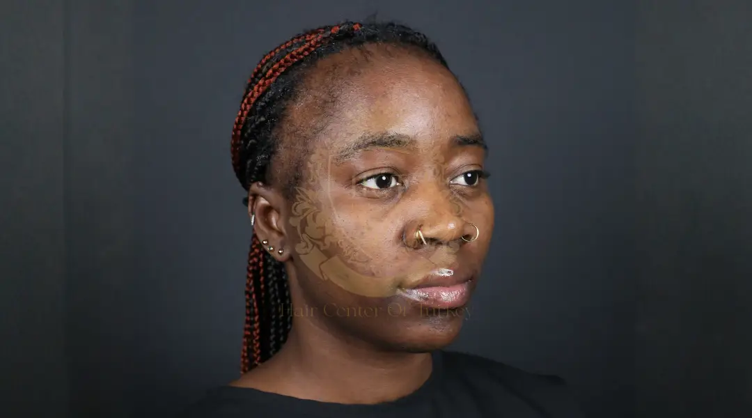 Trasplante Capilar Afro en Turquía