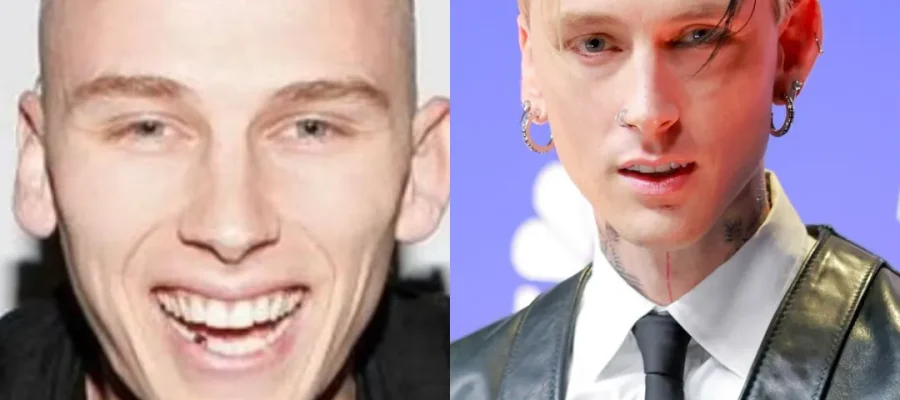 MGK Hair Transplant