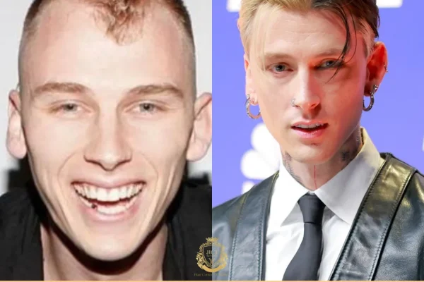 Machine Gun Kelly Saç Ekimi