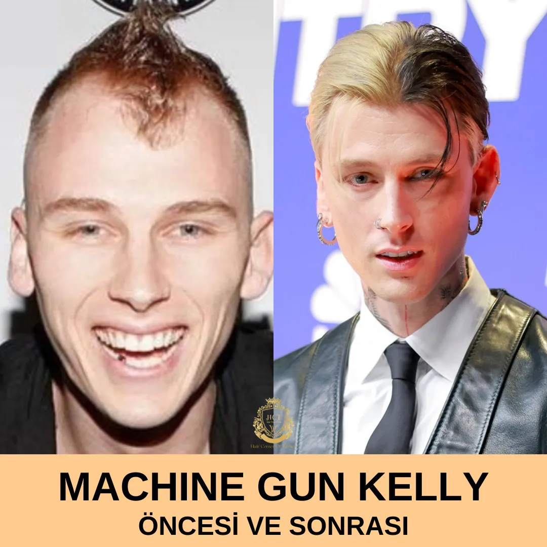 MGK Hair Transplant|MGK Saç Ekimi