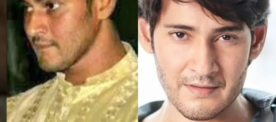 mahesh babu Hair Transplant|Mahesh Babu Saç Ekimi