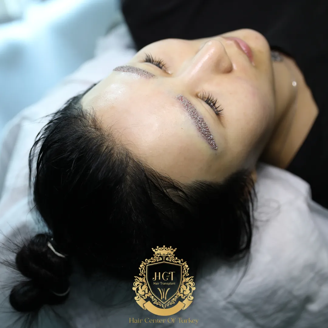 Mikro FUE Kaş Nakli Nedir? 1 Micro FUE Kaş Ekimi Nasıl Yapılır