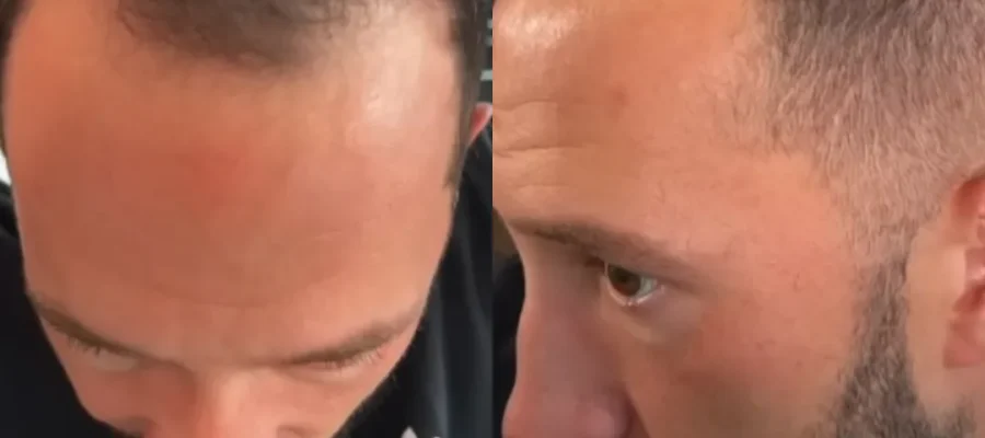 Mike Majlak Saç Ekimi