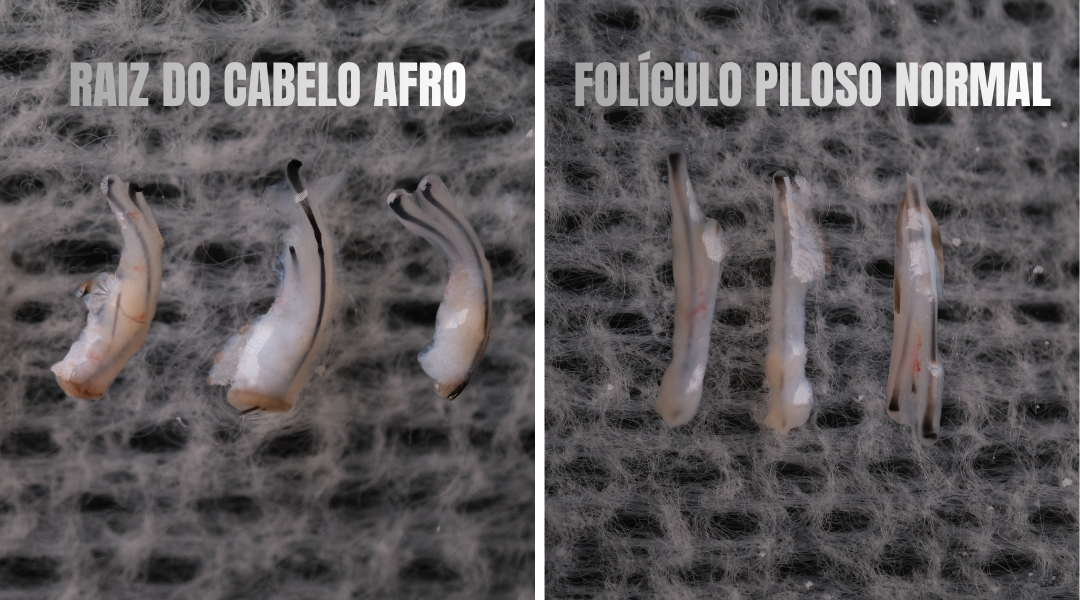 Transplante Capilar Afro na Turquia