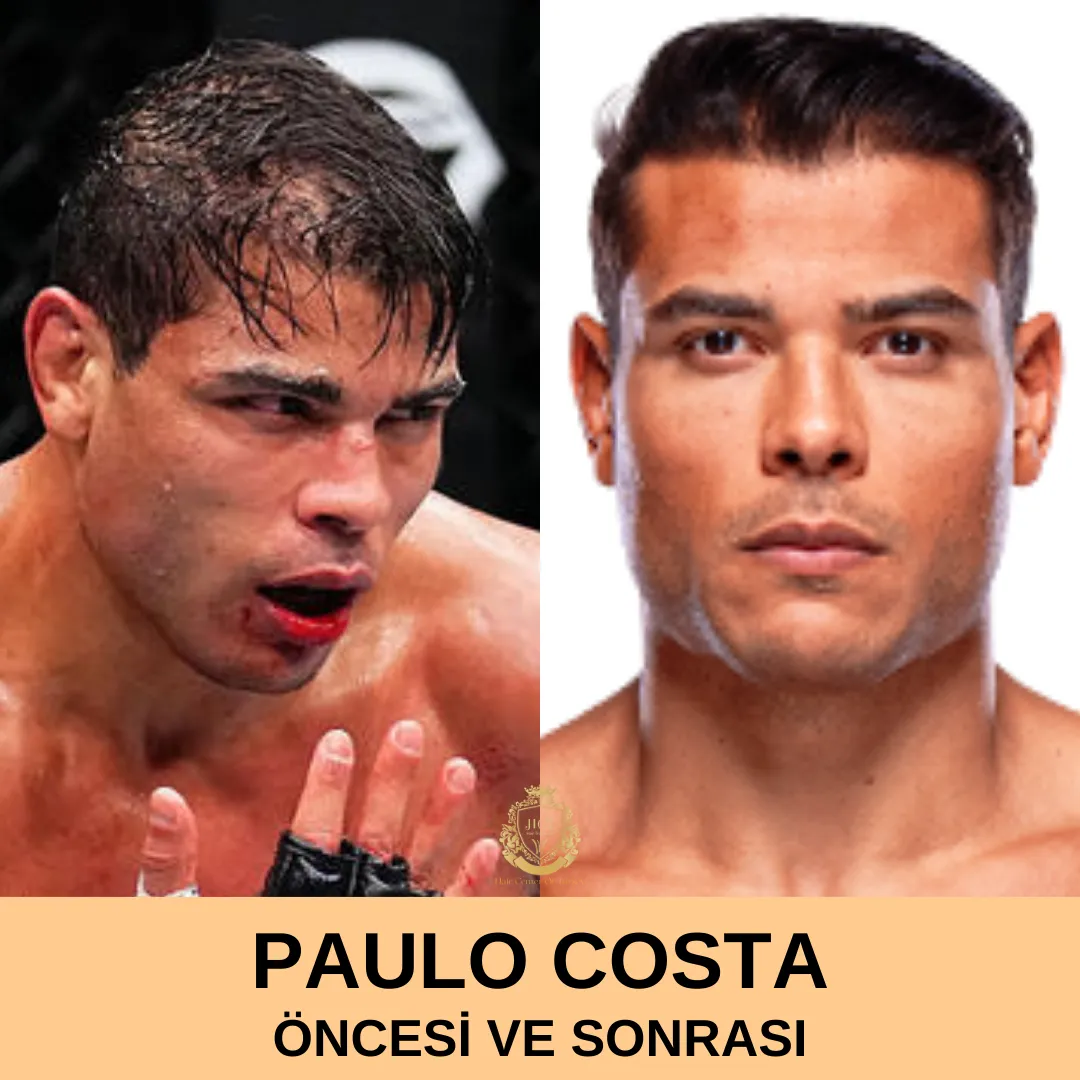 Paulo Costa Hair Transplant Before and After|Paulo Costa Saç Ekimi Öncesi ve Sonrası