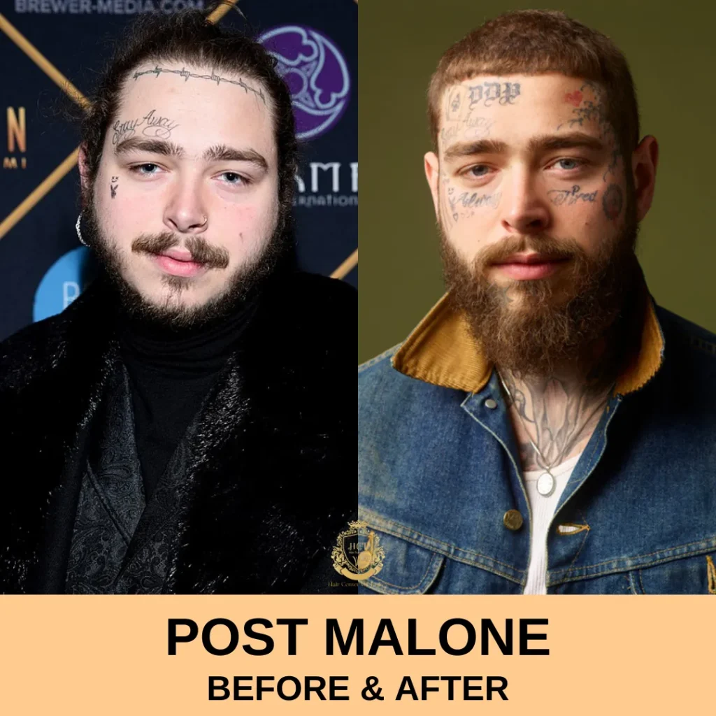 Trapianto di capelli di Post Malone befaf