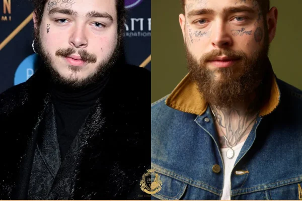 Post Malone Haartransplantation