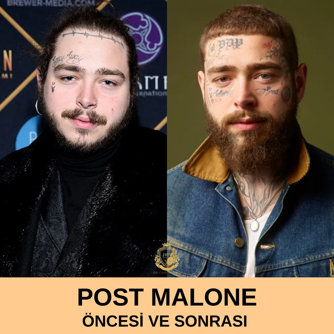 Post Malone Saç Ekimi 1 Post Malone Hair Transplant|Post Malone Saç Ekimi