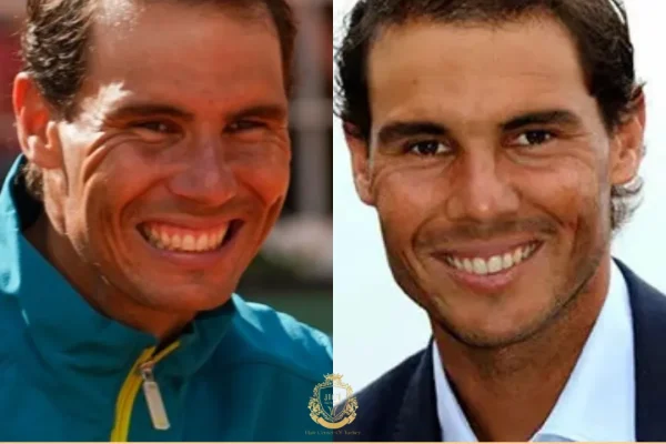 Rafael Nadal Saç Ekimi